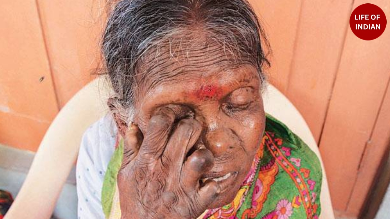 Leprosy in India