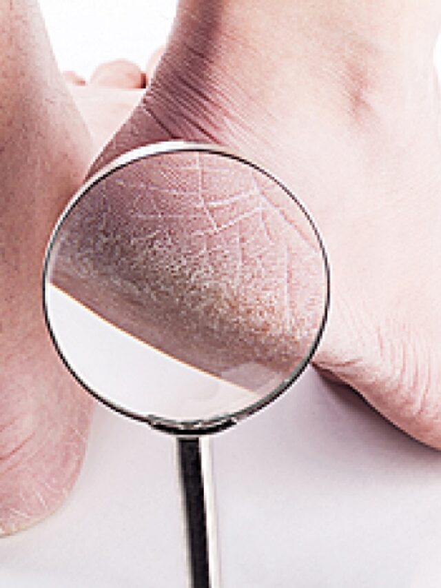 Why Do Heels Crack in Winter? Tips to Prevent It