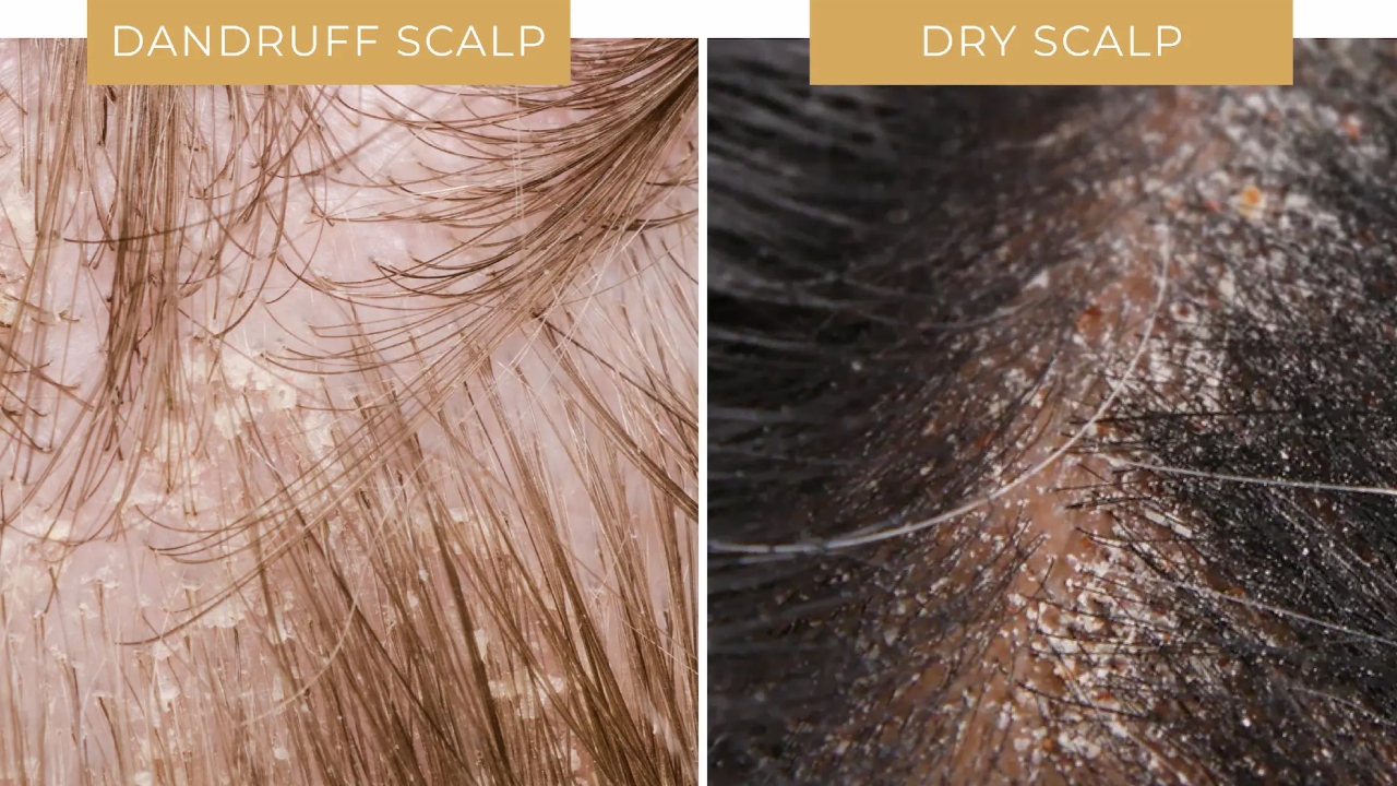 Controls Dandruff and Dry Scalp