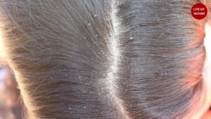 winter dandruff remedy