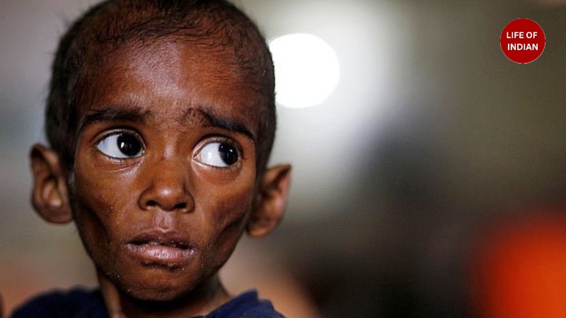 Child Malnutrition Crisis 3